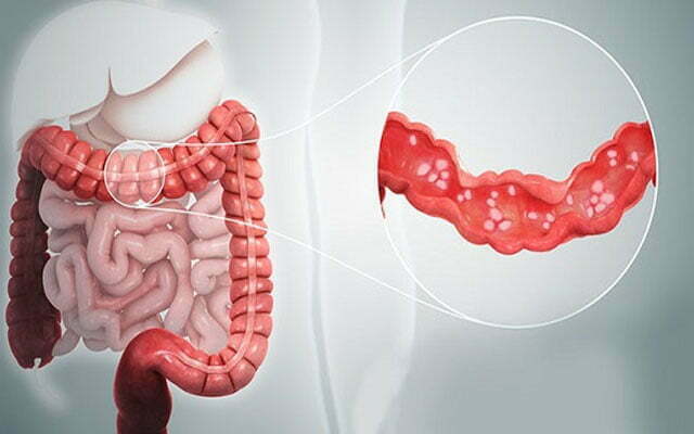Viêm đại tràng giả mạc là tình trạng viêm nhiễm cấp tính biểu hiện bằng việc tiêu chảy, đau quặn bụng…

