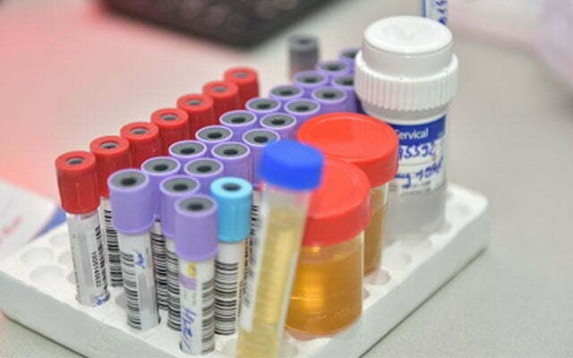 Xét nghiệm máu giúp kiểm tra tỷ số AST/ALT kiểm tra tình trạng gan