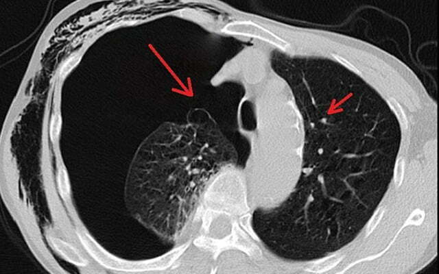 Phim chụp CT phổi của bệnh nhân cho thấy các kén khí (điểm trắng).