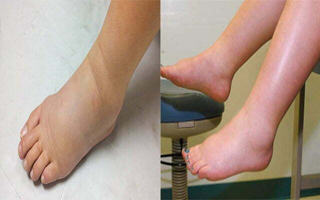 Biểu hiện của bệnh phù ở bàn chân