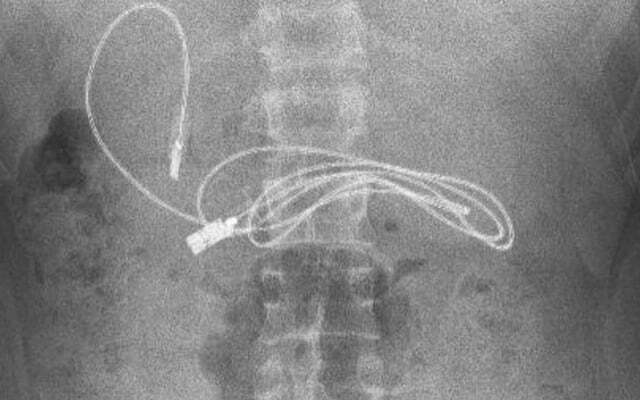 Kết quả chụp X-quang phát hiện sợi dây sạc trong dạ dày của thiếu niên 15 tuổi.